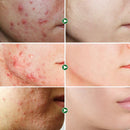 Cremă antiacneică pentru piele